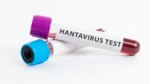 Microscopic view of Hantavirus, a deadly rodent-borne pathogen causing severe respiratory illness.